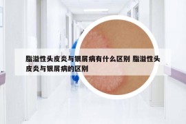 脂溢性头皮炎与银屑病有什么区别 脂溢性头皮炎与银屑病的区别