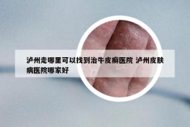 泸州走哪里可以找到治牛皮癣医院 泸州皮肤病医院哪家好