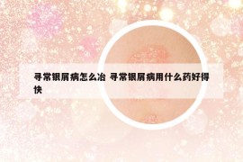 寻常银屑病怎么冶 寻常银屑病用什么药好得快