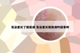 耳朵里长了银屑病 耳朵里长银屑病咋回事啊