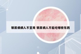 银屑病病人不宜用 银屑病人不能吃哪些东西