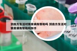 到南方生活对银屑病有帮助吗 到南方生活对银屑病有帮助吗知乎