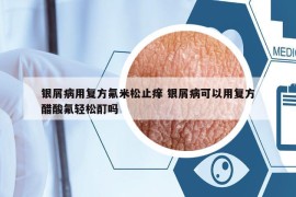 银屑病用复方氟米松止痒 银屑病可以用复方醋酸氟轻松酊吗