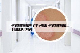 寻常型银屑病哪个季节加重 寻常型银屑病三个阶段多长时间