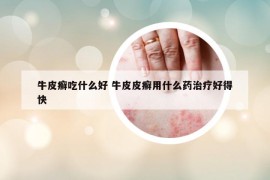 牛皮癣吃什么好 牛皮皮癣用什么药治疗好得快