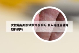 女性绝经后会诱发牛皮癣吗 女人绝经后易得妇科病吗