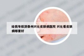 给我导航到泰州兴化皮肤病医院 兴化看皮肤病哪里好