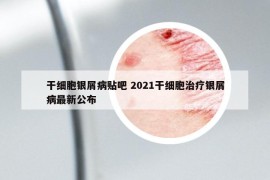 干细胞银屑病贴吧 2021干细胞治疗银屑病最新公布