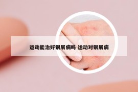运动能治好银屑病吗 运动对银屑病