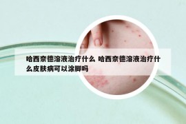 哈西奈德溶液治疗什么 哈西奈德溶液治疗什么皮肤病可以涂脚吗
