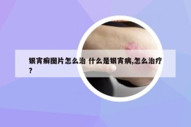 银宵癣图片怎么治 什么是银宵病,怎么治疗?