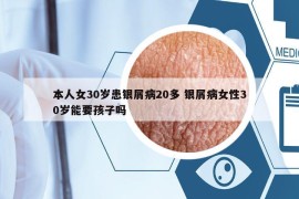 本人女30岁患银屑病20多 银屑病女性30岁能要孩子吗