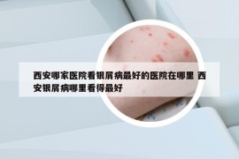 西安哪家医院看银屑病最好的医院在哪里 西安银屑病哪里看得最好