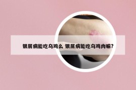 银屑病能吃乌鸡么 银屑病能吃乌鸡肉嘛?