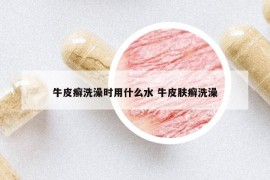 牛皮癣洗澡时用什么水 牛皮肤癣洗澡