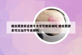 糖皮质激素适用于寻常型银屑病吗 糖皮质激素可以治疗牛皮癣吗