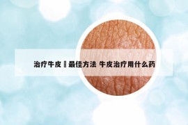 治疗牛皮廯最佳方法 牛皮治疗用什么药