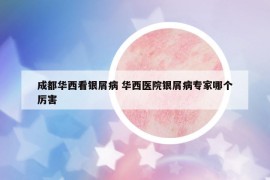 成都华西看银屑病 华西医院银屑病专家哪个厉害