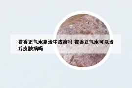 霍香正气水能治牛皮癣吗 霍香正气水可以治疗皮肤病吗