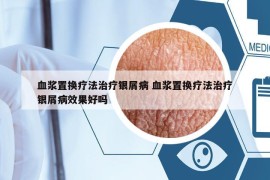 血浆置换疗法治疗银屑病 血浆置换疗法治疗银屑病效果好吗