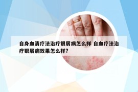 自身血清疗法治疗银屑病怎么样 自血疗法治疗银屑病效果怎么样?