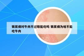 银屑病对牛肉不过敏能吃吗 银屑病为啥不能吃牛肉