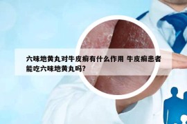 六味地黄丸对牛皮癣有什么作用 牛皮癣患者能吃六味地黄丸吗?