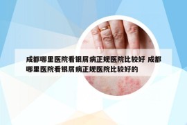 成都哪里医院看银屑病正规医院比较好 成都哪里医院看银屑病正规医院比较好的
