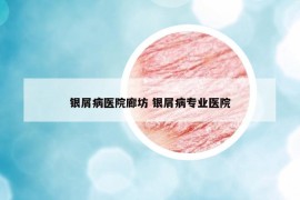 银屑病医院廊坊 银屑病专业医院