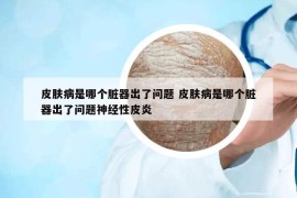 皮肤病是哪个脏器出了问题 皮肤病是哪个脏器出了问题神经性皮炎