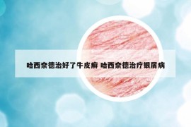 哈西奈德治好了牛皮癣 哈西奈德治疗银屑病