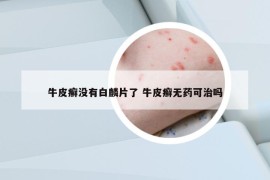 牛皮癣没有白麟片了 牛皮癣无药可治吗