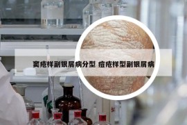 窦疮样副银屑病分型 痘疮样型副银屑病