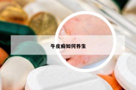 牛皮癣如何养生