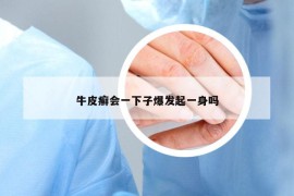 牛皮癣会一下子爆发起一身吗
