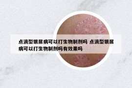 点滴型银屑病可以打生物制剂吗 点滴型银屑病可以打生物制剂吗有效果吗