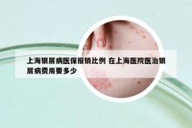 上海银屑病医保报销比例 在上海医院医治银屑病费用要多少
