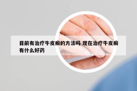 目前有治疗牛皮癣的方法吗 现在治疗牛皮癣有什么好药