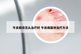 牛皮癣该怎么治疗好 牛皮癣最快治疗方法