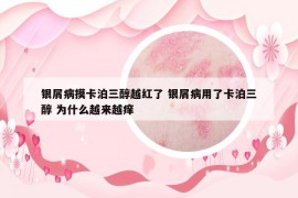 银屑病摸卡泊三醇越红了 银屑病用了卡泊三醇 为什么越来越痒