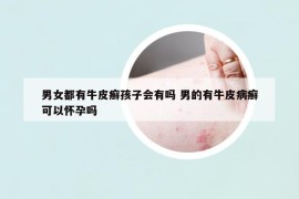 男女都有牛皮癣孩子会有吗 男的有牛皮病癣可以怀孕吗