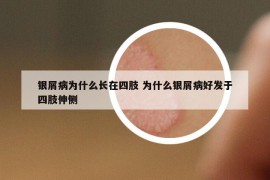 银屑病为什么长在四肢 为什么银屑病好发于四肢伸侧