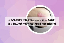 全身发痒抓了起红疙瘩一片一片的 全身发痒抓了起红疙瘩一片一片的用海南米酒治得好吗
