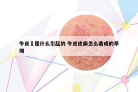 牛皮癬是什么引起的 牛皮皮癣怎么造成的早期