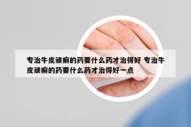 专治牛皮顽癣的药要什么药才治得好 专治牛皮顽癣的药要什么药才治得好一点