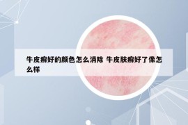 牛皮癣好的颜色怎么消除 牛皮肤癣好了像怎么样