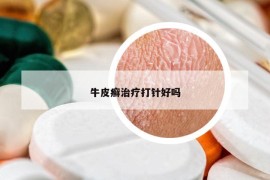 牛皮癣治疗打针好吗