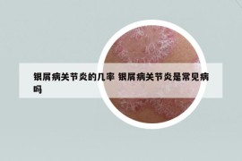 银屑病关节炎的几率 银屑病关节炎是常见病吗