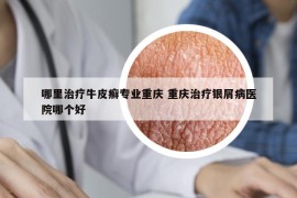 哪里治疗牛皮癣专业重庆 重庆治疗银屑病医院哪个好