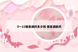 il一23银屑病药多少钱 银屑病新药